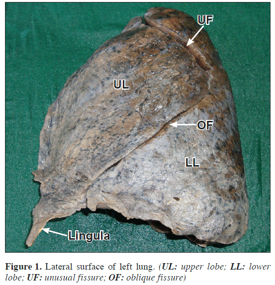 anatomical-variations-left-lung