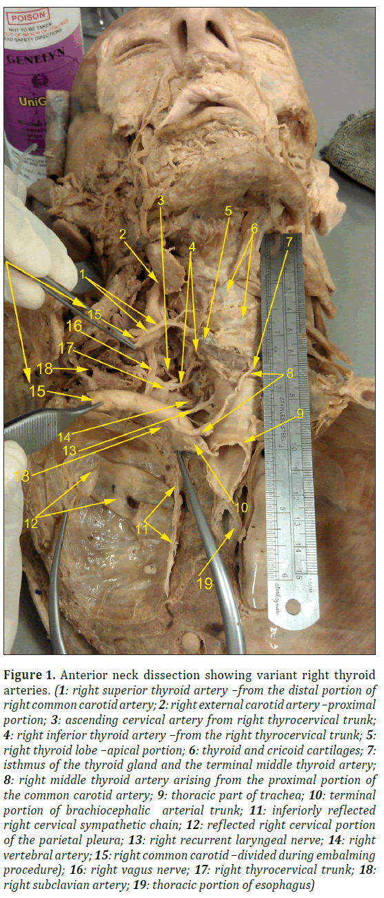 anatomical-variations-thyroid-artery