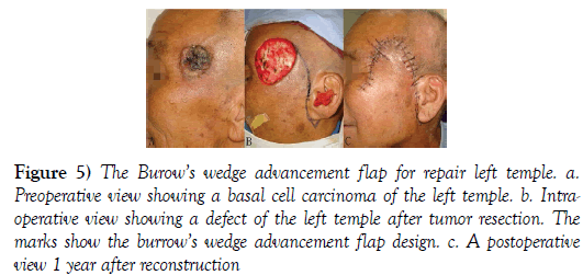 surgery-case-report-basal-cell-carcinoma